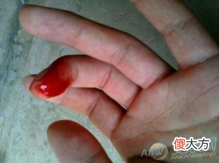 梦见手指流血不止是吉是凶？了解梦境含义(图文)