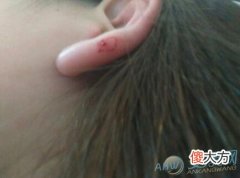 梦见被虫子咬出血的吉凶含义解读(图文)