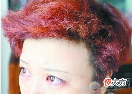 梦见头发被烧(图文)