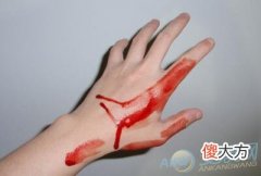 梦见自己的手流血(图文)