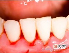 梦到牙齿流血(图文)