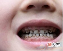 谨言慎行！梦见牙齿变黑相关含义解析(图文)