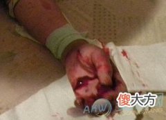 梦见自己打架流血代表着什么？注重梦境变化(图文)