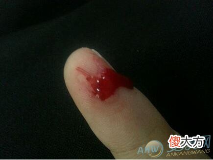 梦见拇指出血(图文)