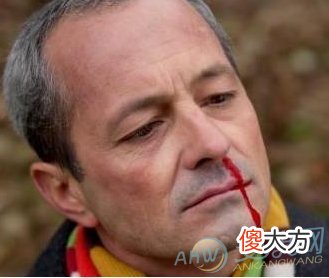 绝对不是好事！梦到鼻子出血介绍(图文)
