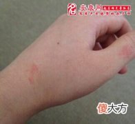 梦见手变红(图文)