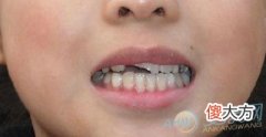 梦见牙断了(图文)