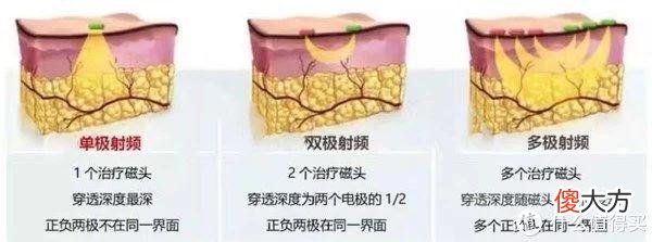 【时尚一点】婚礼前三个月才开始急救护肤，现在入手巧本双头美容仪晚不？超全的美容仪选购经验分享！