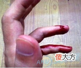如何解读梦见亲人受伤流血所具有的含义特点？(图文)