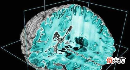 男子大脑消失75%仍在正常生活工作，爱因斯坦早就证明脑容量不能决定一切