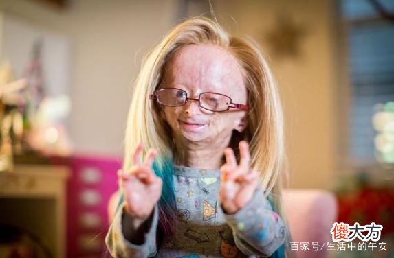 19岁菲律宾花季少女，不幸患上顽症，被人误认为是百岁老妇！