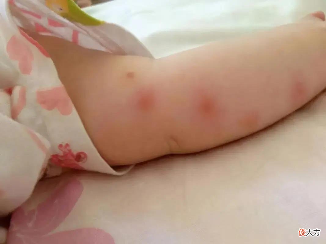孩子被蚊子叮咬，妈妈两个动作避免娃皮肤肿痛，医生：做得对