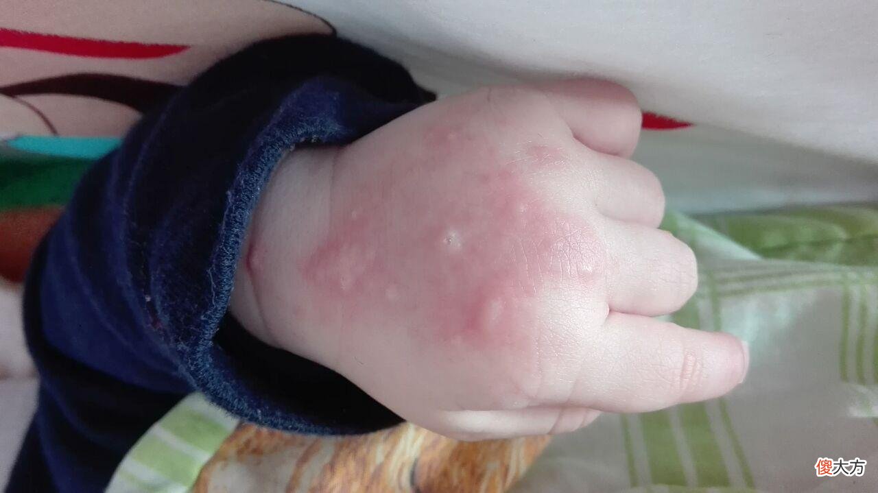 孩子被蚊子叮咬，妈妈两个动作避免娃皮肤肿痛，医生：做得对