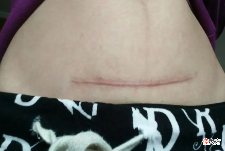 剖腹产后几天才能出院？跟顺产产差别大，看3点，不是越早越好