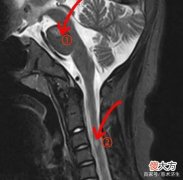 9岁女孩突然“双目失明”，上海德济陈伟民主任治疗仅3天重见光明