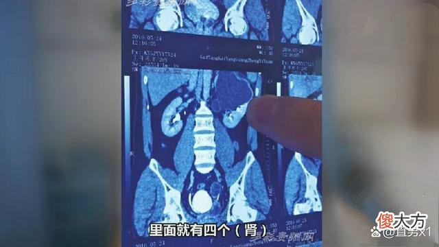 家族双生现象！28岁小伙天生4个肾，父亲一人就有24个指头