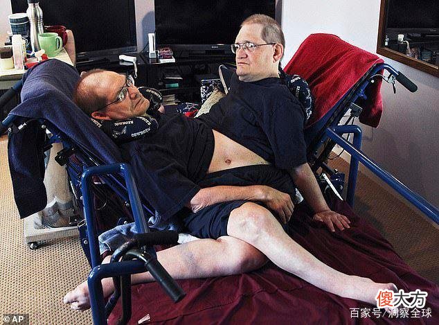 世界最长寿连体双胞胎离世，享年68岁，他们说自己的生活很美好