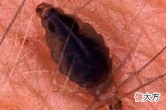 梦见自己头上有虱子并挤死