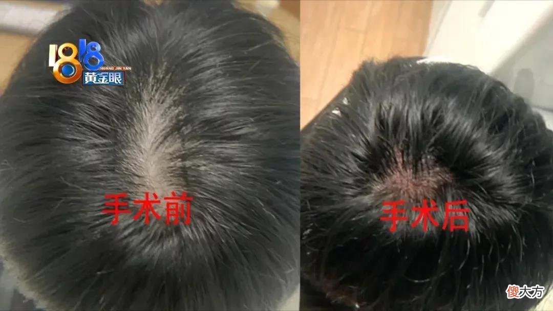 【时尚一点】帅气小张“植发”后   左看右看“不如前”