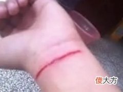梦见自己被伤出血