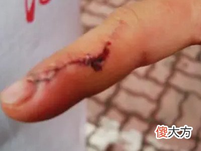 梦见咬出血了