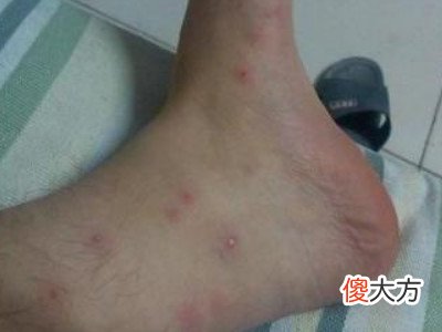 梦到别人身上生疮