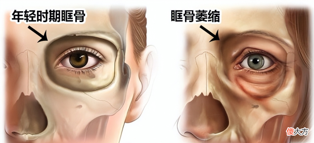 【就爱时尚】眼窝凹陷才是“毁容利器”，堪称女明星的“颜值杀手”