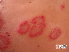梦见身上有疮