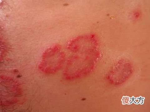 梦见身上有疮
