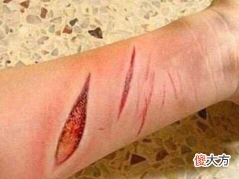 梦见手臂受伤