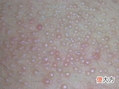 梦见身上长了密密麻麻的疙瘩