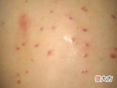 梦见身上长红疹子