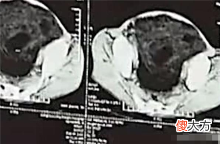 老人五脏六腑凭空消失，毫无异样活了50年，检查后医生直摇头