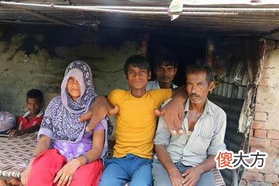 男孩出生就得怪病，手竟长到了40厘米，穿衣都成问题！！