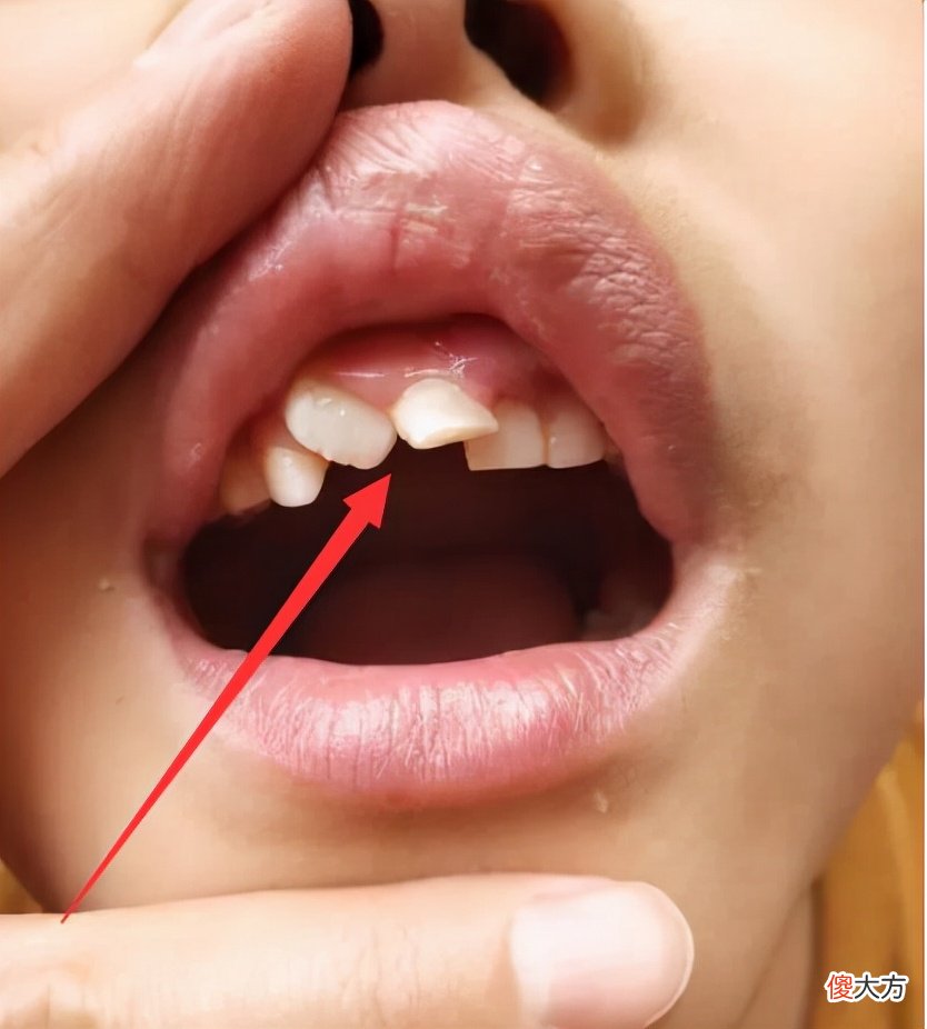 孩子换牙齿，新长的牙齿是歪的或双排牙，可能是家长没做好这些