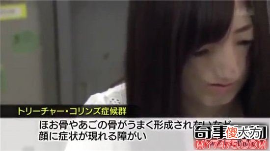 无脸症非常吓人 突变细胞改变基因影响面部