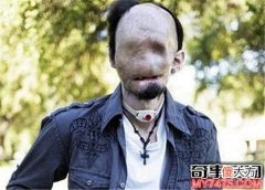 无脸症非常吓人 突变细胞改变基因影响面部
