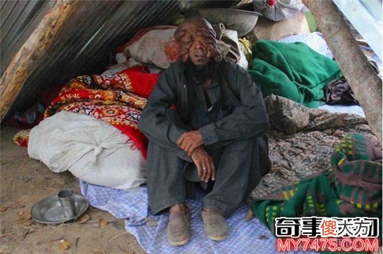 无脸症非常吓人 突变细胞改变基因影响面部