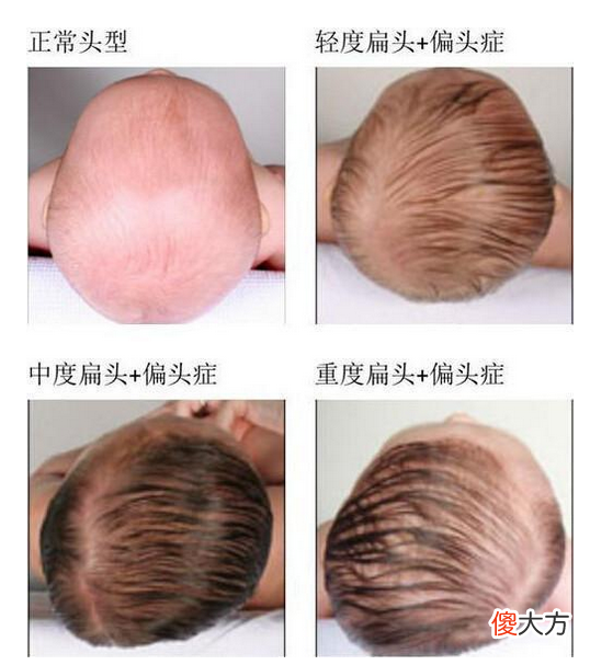 “脑勺高，聪明包”，这种头型的娃智商高人一等？家长别被误导