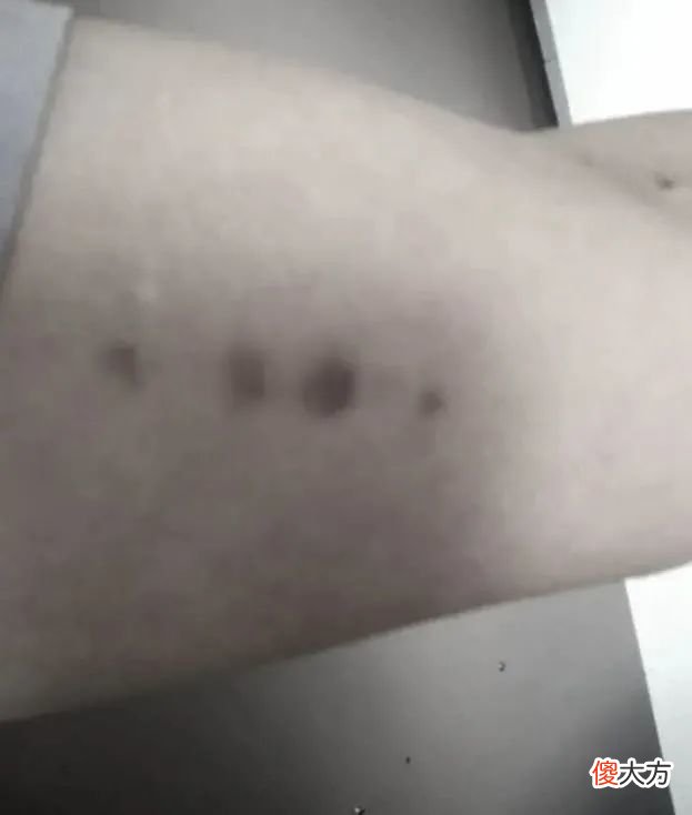 女子展示神秘形状瘀伤作证：被外星人绑架52次？