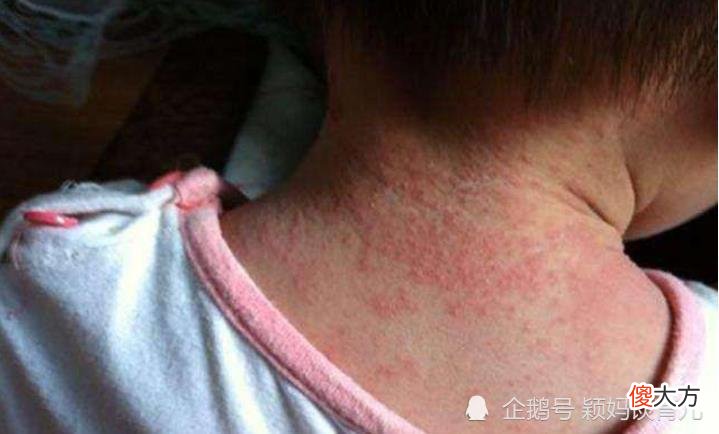 炎炎夏日，幼儿容易出现这类皮肤问题，防护指南来了