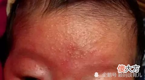 炎炎夏日，幼儿容易出现这类皮肤问题，防护指南来了