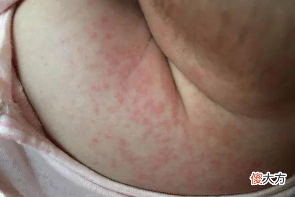 新生儿长痱子，为什么勤洗澡也退不了？医生一句话让宝爸恍然大悟