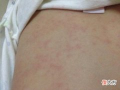 新生儿长痱子，为什么勤洗澡也退不了？医生一句话让宝爸恍然大悟