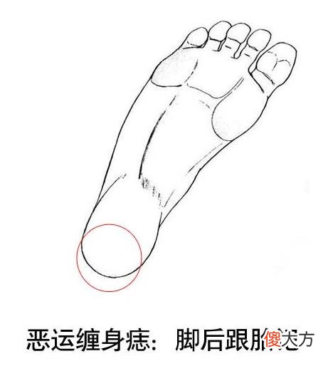 5大胎记影响你的运势！