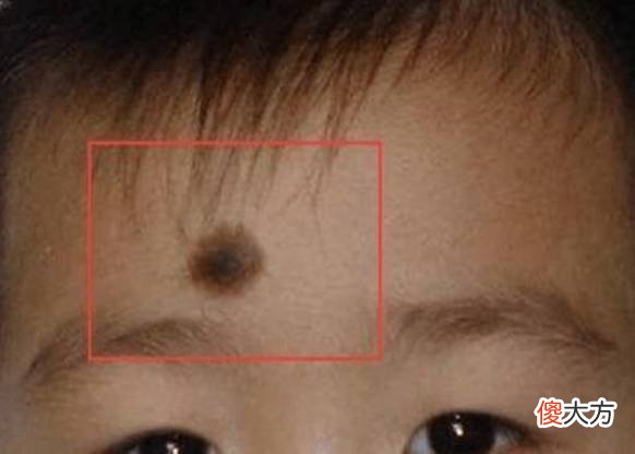 “上帝的吻痕”要不要去掉？医生：胎记去不去，还是要看部位