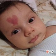 “上帝的吻痕”要不要去掉？医生：胎记去不去，还是要看部位