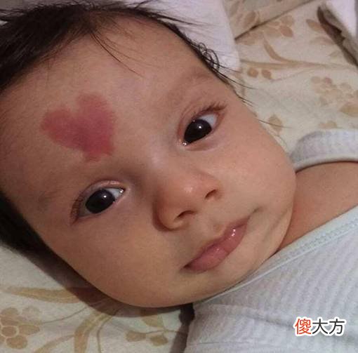 “上帝的吻痕”要不要去掉？医生：胎记去不去，还是要看部位