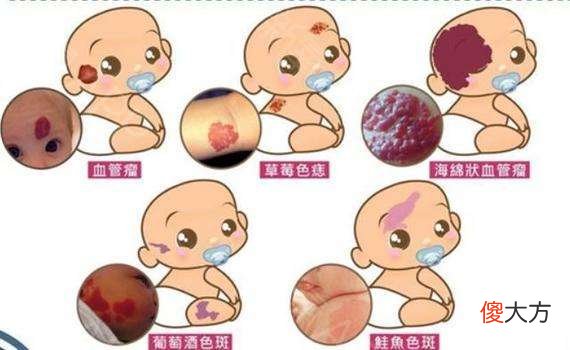 “上帝的吻痕”要不要去掉？医生：胎记去不去，还是要看部位