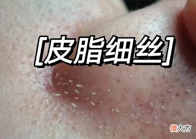 【就爱时尚】黑头、毛孔粗大、鼻翼泛红……鼻子4种皮肤问题这样应对！